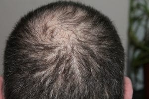 Haarausfall: Die Ursachen & so kannst Du die Alopezie behandeln!